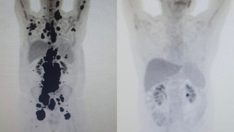 Terapia celular no SUS promove remissão completa de câncer em paciente após 13 anos de luta