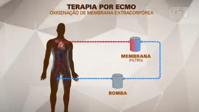 MC Marcinho recebe terapia ECMO, que funciona como pulmão artificial, após parada cardiorrespiratória
